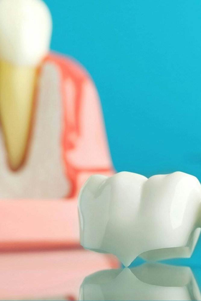 Dental Bridges